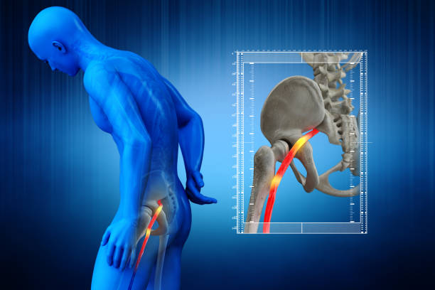 Physical Therapy in San Antonio for Back - Piriformis Syndrome